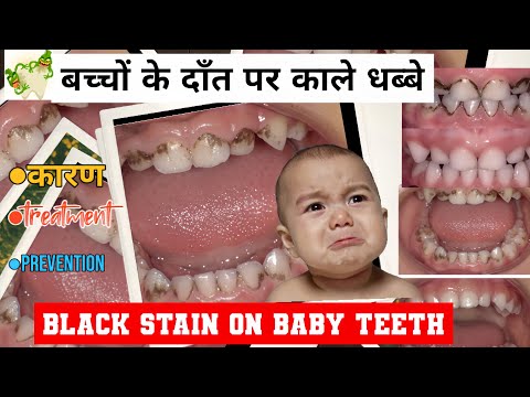 BLACK STAINS ON BABY TEETH?बच्चों में काले धब्बेवाले दाँत@yourdentists #plaque#kids #dentalhygiene