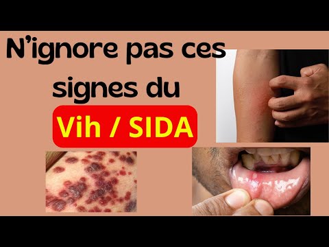 Quels sont les 13  signes du VIH / SIDA ?