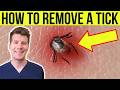 Doctor explains HOW TO REMOVE A TICK | Step-by-step guide