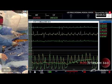 TAVI using Navitor 25mm SEV