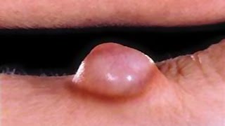 Sebaceous Cyst, Bot Fly, Blackheads - Medical Trivia Game