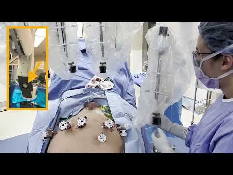 Core Videos (2022): Multi-Port Docking: Da Vinci Xi