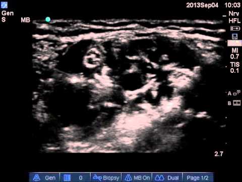 Ultrasound guided axillary brachial plexus block.