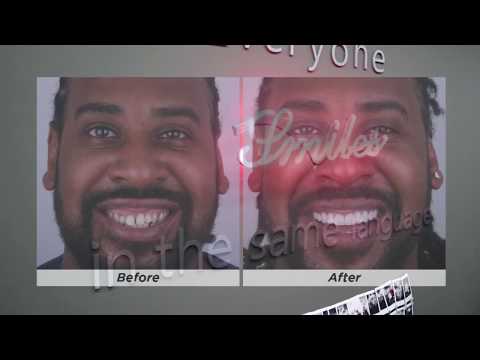 Emax crowns and Emax Laminate Veneers. - Exclusive Dental Turkey