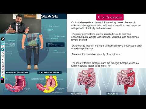 نزيف الجهاز الهضمي | Approach to Upper Gastrointestinal Bleeding - causes, symptoms and treatment