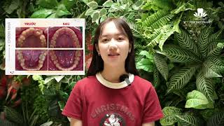 Bạn Tường Vy chia sẻ sau khi kết thúc chỉnh nha
