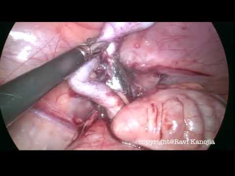 Laparoscopic Appendectomy in a Pediatric Patient