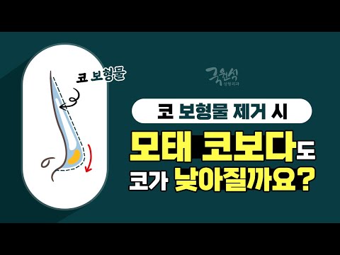 #코보형물제거 후, 코가 모태 코보다도 낮아지면 어쩌죠?
