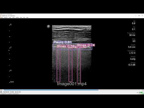 Thumbnail for covEcho 14 Point Lung Ultrasound Scan video