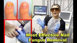 Toenail most effective fungus removal treatment with Laser (2023)