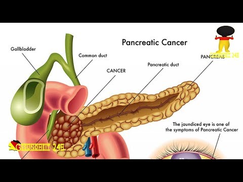 Chronische Pankreatitis