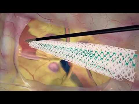 DynaMesh® - ENDOLAP 3D von FEG