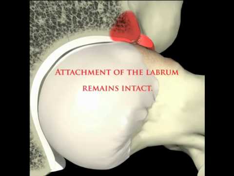 Cam Impingement