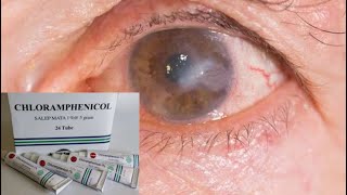 Download lagu Chloramphenicol Eye Ointment Information To treat various eye infections #chloramphenicol mp3 Download lagu Chloramphenicol Eye Ointment Information To treat various eye infections #chloramphenicol mp3
