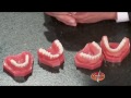 Mini Dental Implant Dentures
