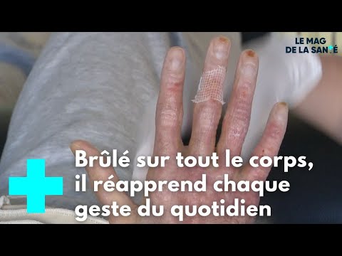 Grands brûlés : une longue convalescence - Le Magazine de la Santé