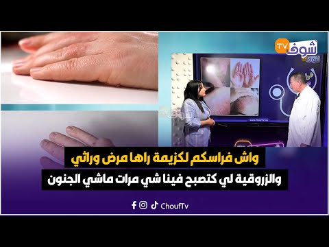شوف صحتك .. واش فراسكم لكزيمة راها مرض وراثي والزروقية لي كتصبح فينا شي مرات ماشي الجنون