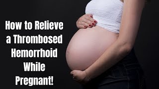 How to Relieve a Thrombosed Hemorrhoid While Pregnant