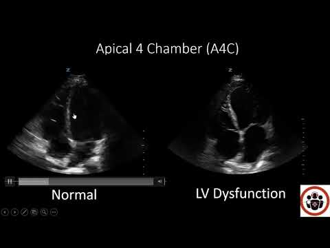 POCUS Cases 3: LV Systolic Dysfunction