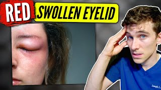 Swollen Eyelid: (causes & solutions) - Eye Doc