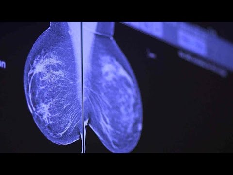 How To Catch Breast Cancer Early: Stanford Doctors Explain Mammography Options