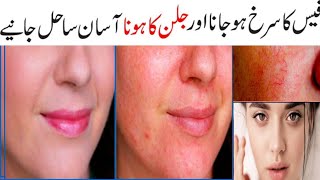 how to remove face redness naturally face redness treatment skin care redness on face