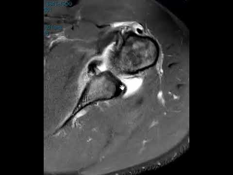 Hill-Sachs and Bony Bankart Lesions