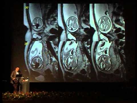 Spesso una nuca mal di collo Come aiutare se stessi in osteocondrosi