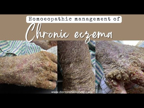 Chronic eczema