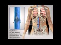 IVC Filter Complications - Medical Animation