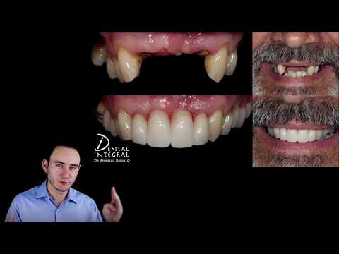 Los Implantes Dentales No Son Para Todos Los casos