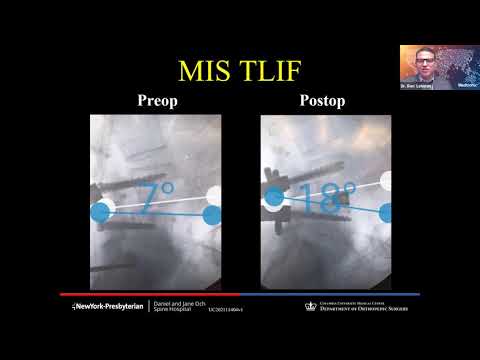Lecture: TLIF for Deformity Applications