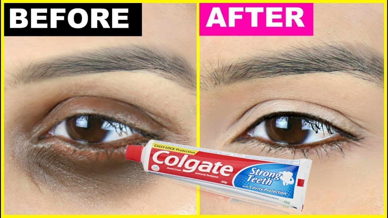 Colgate வெறும் 1 நிமிஷத்துல உங்க கண் கருவளையங்களை(Dark Circles)காணாமலாக்கிடும் | DARK CIRCLES REMOVE
