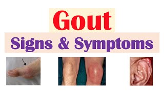 Gout Signs and Symptoms (& Why They Occur)