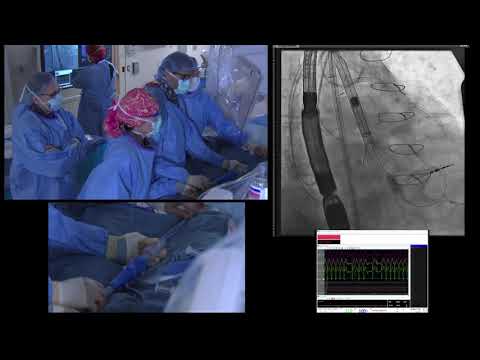 TAVR Utilizing the Medtronic Evolut Pro Transcatheter Heart Valve