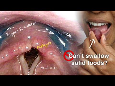 Cricopharyngeal Dysfunction: Difficulty Swallowing, Especially Solid Foods