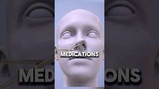 Nasal polyps removal process