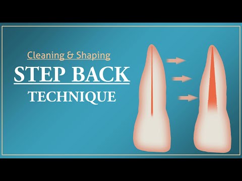 Step Back Technique | Root Canal Treatment