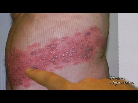 shingles vă fac să pierdeți în greutate