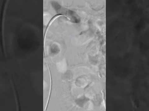 Varicocele embolization live case - Step 12 #nosurgery  | Dr. Gaurav Gangwani