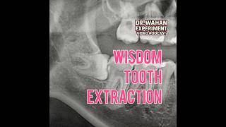 Horizontal Wisdom Tooth Extraction