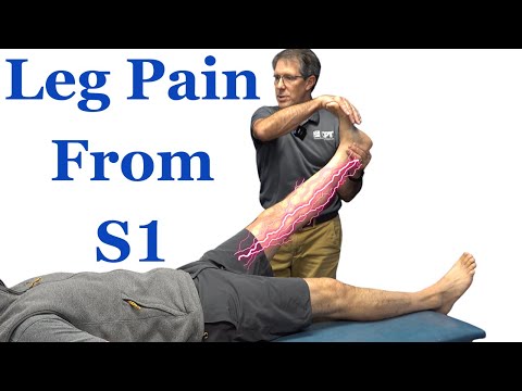 Leg Pain from S1 Nerve Root Compression (Most COMMON Signs and Symptoms)