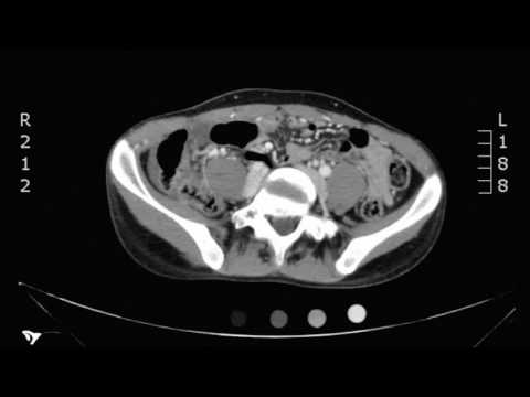 Appendicitis Unannotated Video, CT. JETem 2017.