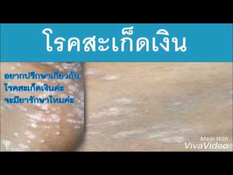 โรคสะเก็ดเงินที่เล็บด้วยการเดินเท้า กลากจุลินทรีย์บนเล็บ