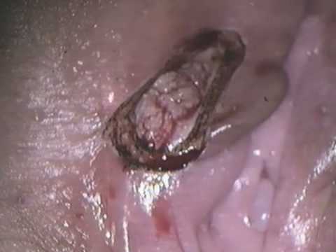 CO2 Laser in gynaecology – Part 2