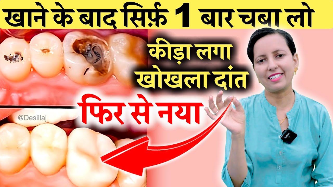 खाने के बाद सिर्फ़ 1 बार चबा लो कीड़ा लगा ,खोखला दांत फिर से नया | Teeth Cavity