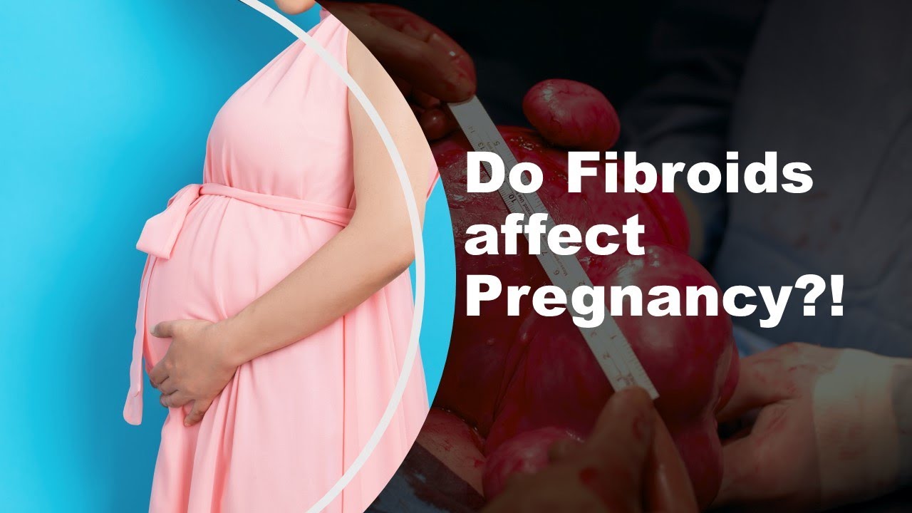 Do Uterine Fibroids Affect Pregnancy?!