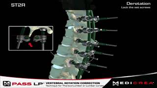 Medicrea Spinal Surgery Implant