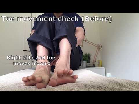 Toe movement check before acupuncture