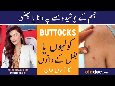 HOW TO REMOVE BUTTOCKS ACNE - Baghal Men Dana Nikalna - Hips/Underarm Pimple Treatment In Urdu/Hindi